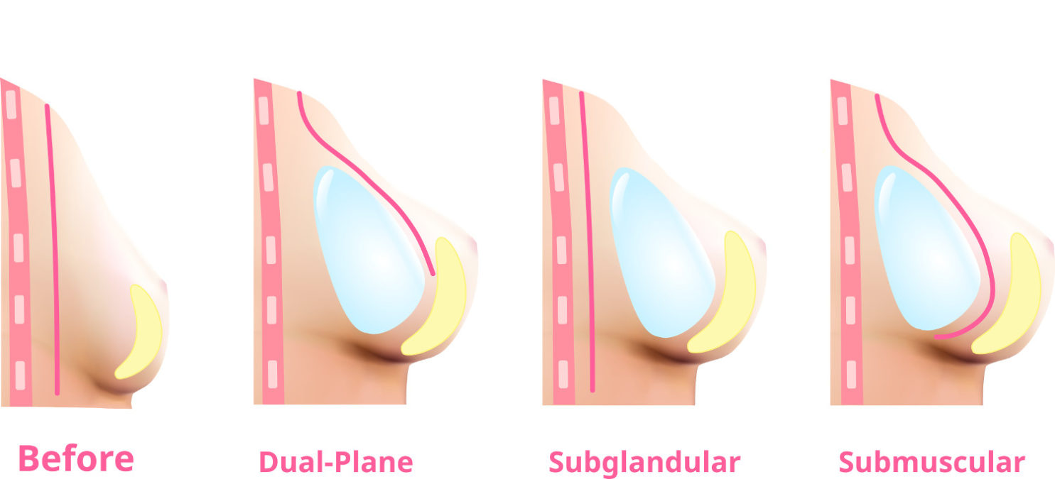Schéma des principales positions de prothèses mammaires, avec implants placés sous la glande, en dual plane et sous le muscle